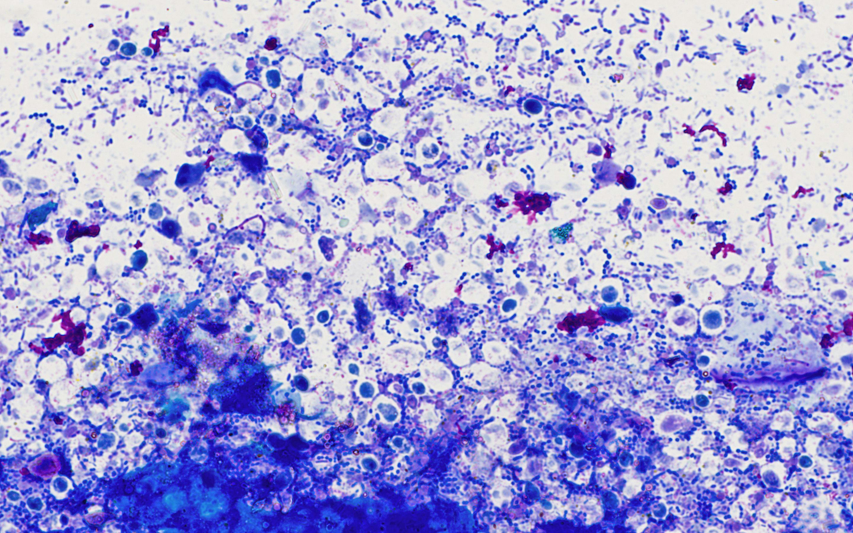 Figure 2. Rectal scrape from a 1-year-old, spayed female, mixed breed dog presented for evaluation of chronic diarrhea. There is an impressive number of fecal yeast and bacterial cocci are overrepresented, consistent with dysbiosis. The dog was undergoing antibiotic therapy and receiving probiotics, both known contributors of yeast overgrowth. Wright-Giemsa, 1000x magnification.