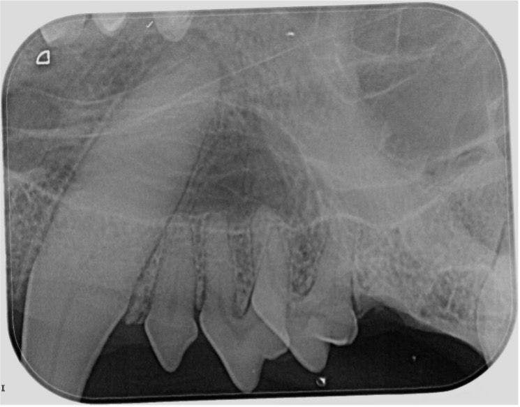 Figure 6: Radiograph of crowded teeth