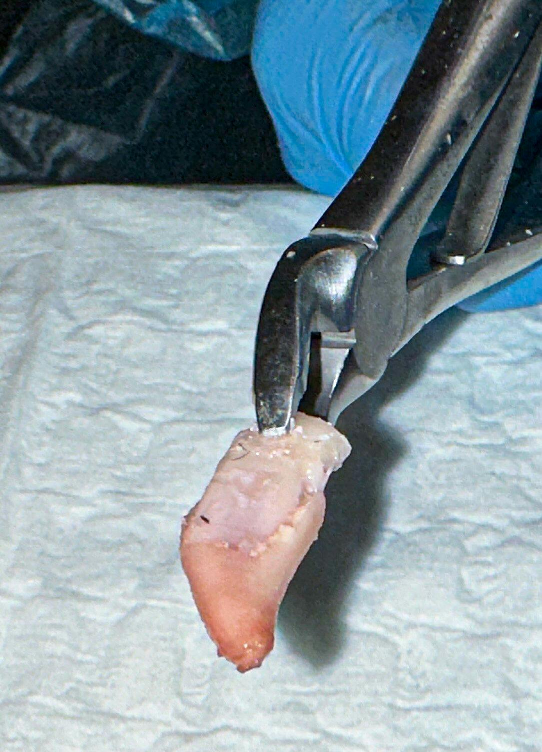 Delivery of the maxillary canine root is shown.