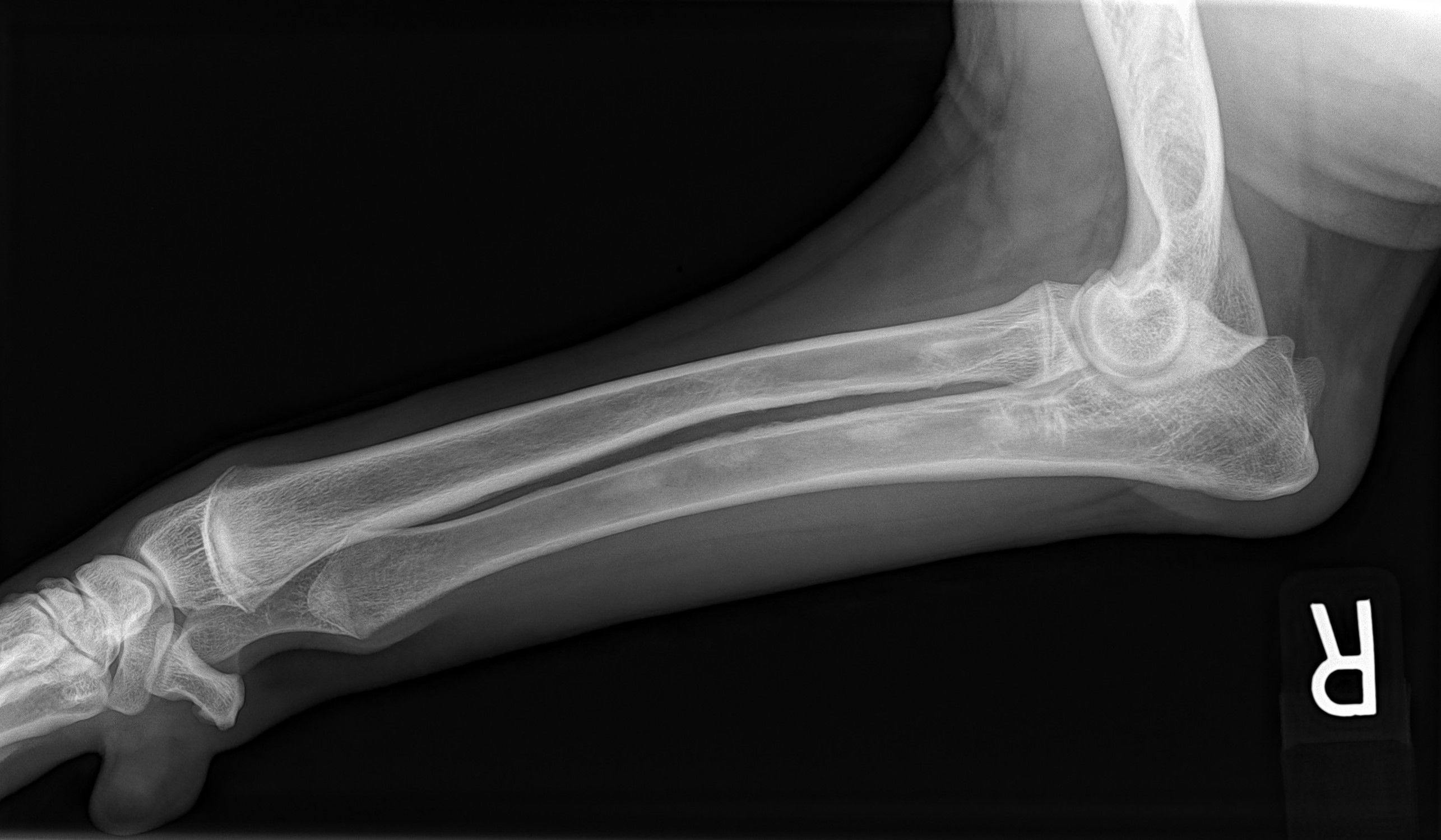 Figure 2. A mediolateral projection of the right radius/ulna belonging to a 10-month-old German Shepherd with a right forelimb lameness diagnosed as panosteitis. In the diaphyseal ulna, and, to a lesser degree, the radius, one can see the patchy regions of increased granular opacity and loss of normal trabecular pattern. There is also subtle increased periosteal reaction along the proximal diaphyseal ulna. (Radiograph courtesy of Jeff Haymaker, VMD)