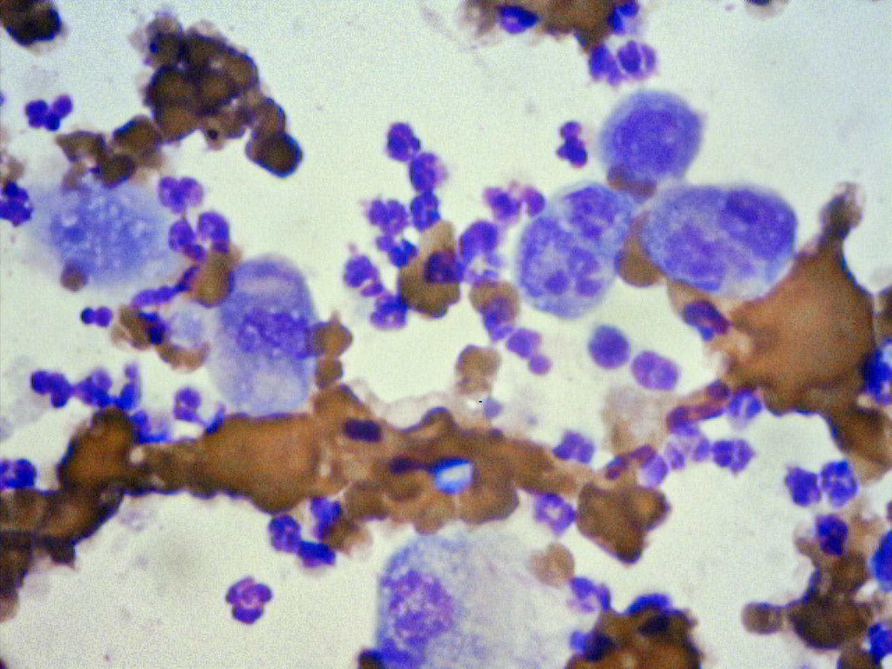 Figure 9B: Cytologic criteria of malignancy include increased nuclear/cytoplasm ratio, nuclear and nucleolar pleomorphism consistent with squamous cell carcinoma.