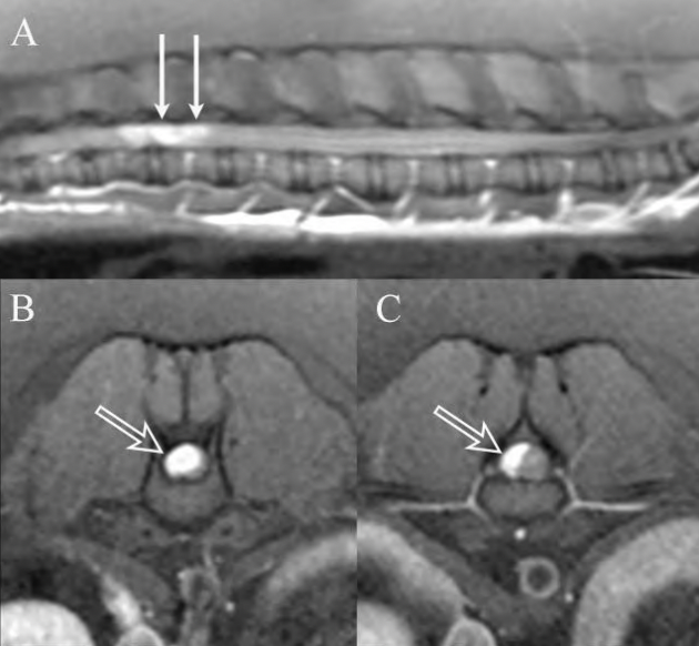 Figure 1. MRI Appearance Of Intradural-Extramedullary Mass. 

Postcontrast T1-weighted sagittal and transverse MRI images showing homogenous strongly contrast-enhancing right-sided intradural-extramedullary mass (arrows) associated with the T13-L1 vertebrae. Solid arrows in panel A denote the approximate level of the transverse images in panels B and C (open arrows). Notice the severe compression of the spinal cord.