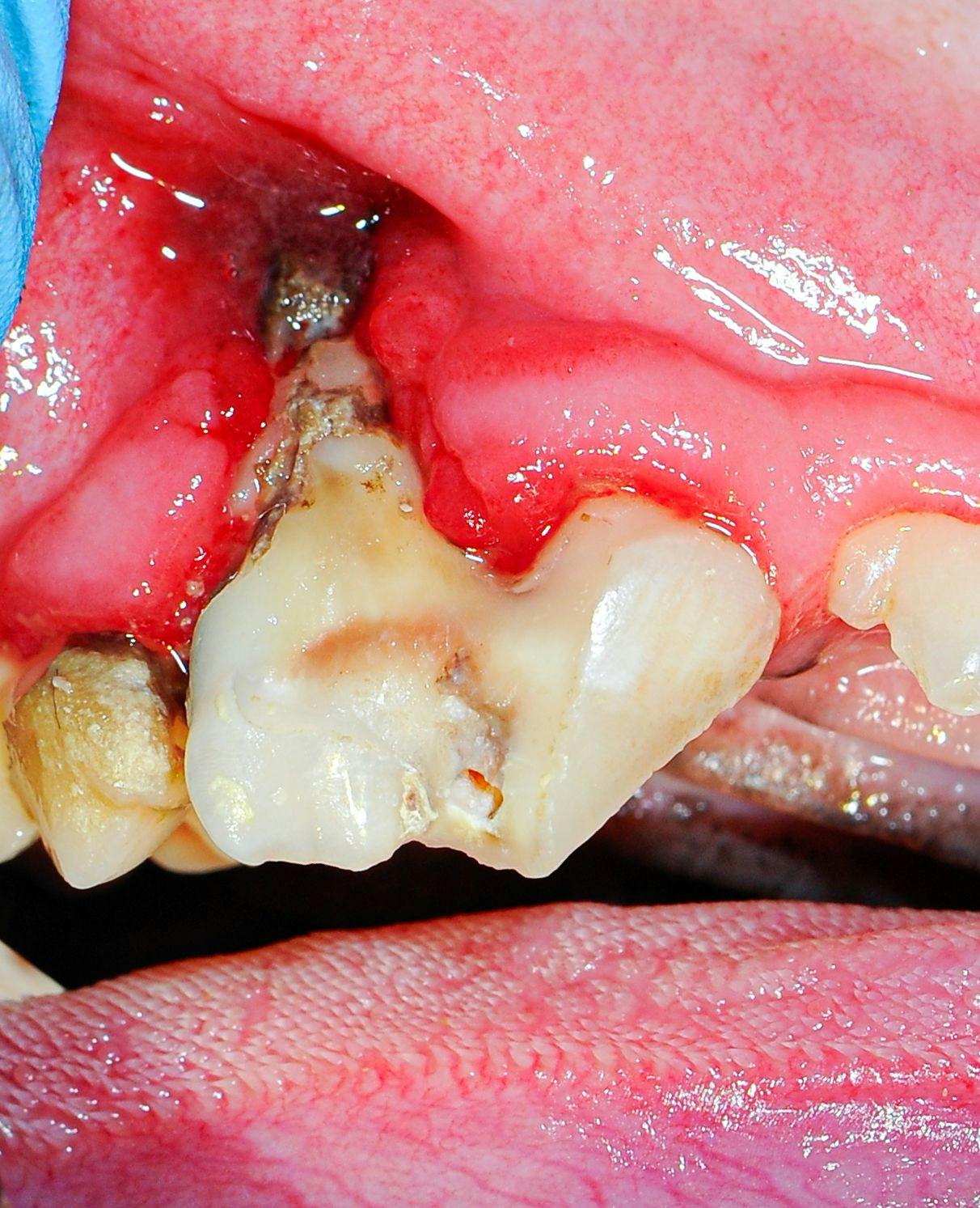 Figure 5: Fractured right maxillary fourth premolar affected with advanced periodontal disease, extraction indicated.