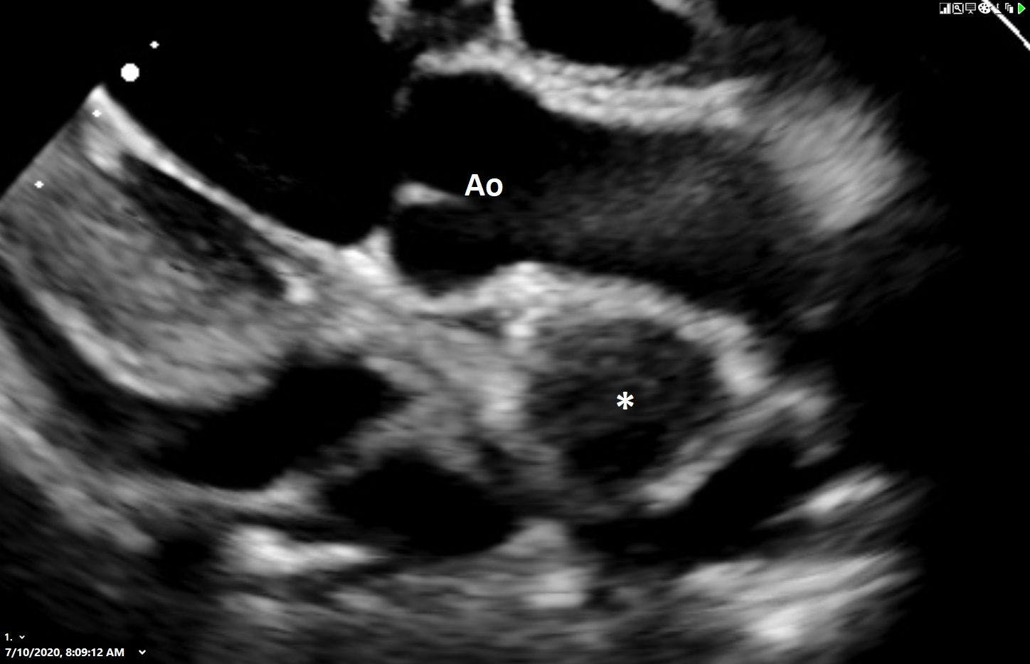 Figure 3. Left intercostal long-axis view depicting the left ventricular outflow tract. A well-demarcated, homogeneous, soft tissue mass (asterisk) can be seen along the ascending aorta. The echocardiographic diagnosis in this middle-aged boxer was a heart base tumor. Based on the mass location and patient signalment, the tentative diagnosis was an aortic body tumor (chemodectoma). The differential diagnosis would include an ectopic thyroid carcinoma or adenoma.