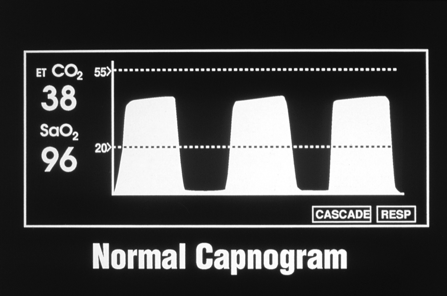 normal capnogram