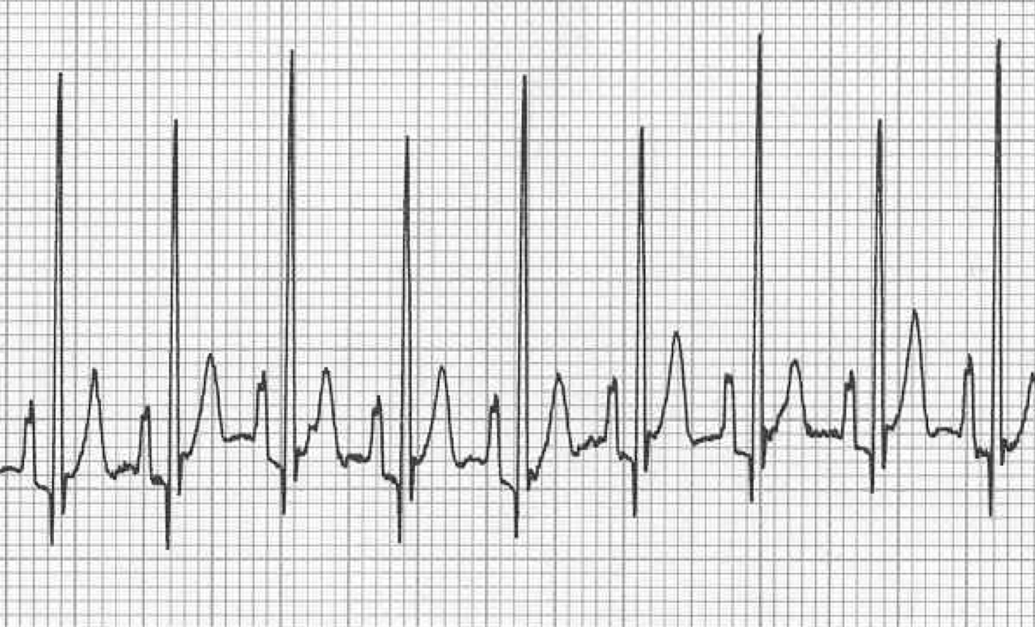 Figure 4: Lead II electrocardiogram showing atrial tachycardia with an average heart rate of 180 bpm. Additionally, the 1:1 variation in R-wave amplitude is consistent with a diagnosis of electrical alternations, a common finding in patients with large volume pericardial effusion.