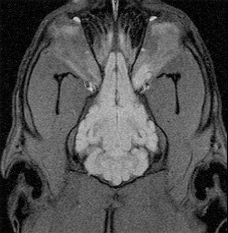 MRI or right optic nerve