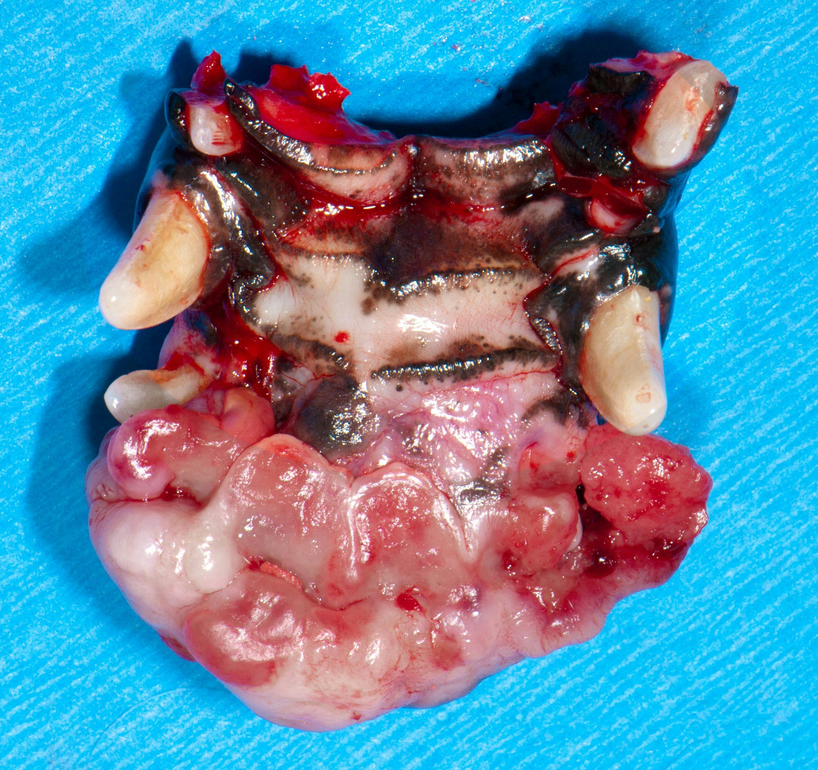 Figure 5: Curative excision with greater than 2 cm clean surgical margins in all directions.