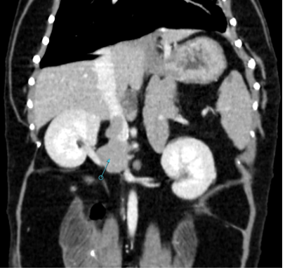 Figure 6. A well-defined right adrenal mass (arrow) can be seen invading the adjacent caudal vena cava as a fingerlike tumor thrombus within this canine patient on CT.