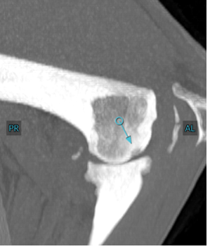 Figure 8. Although medial coronoid fragmentation was evident on radiography in this patient, the adjacent osteochondral lesion of the medial humeral condyle (arrow) was only noted on CT. CT also allowed better evaluation of joint incongruity.