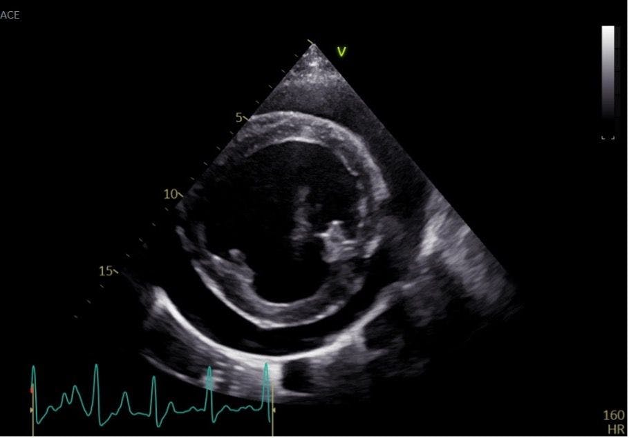 Figure 5: Right parasternal short axis view obtained at the level of the mitral papillary muscles. A large anechoic separation is noted between the epicardium and the pericardium characteristic of pericardial effusion.