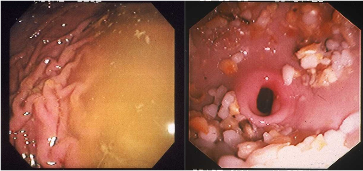 Endoscopic clues to gastric retention