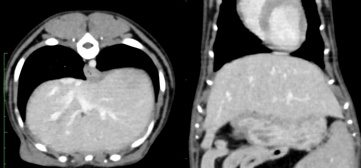 Figure 2: Transverse and dorsal post-contrast CT images show a normal liver with no gallbladder present.
