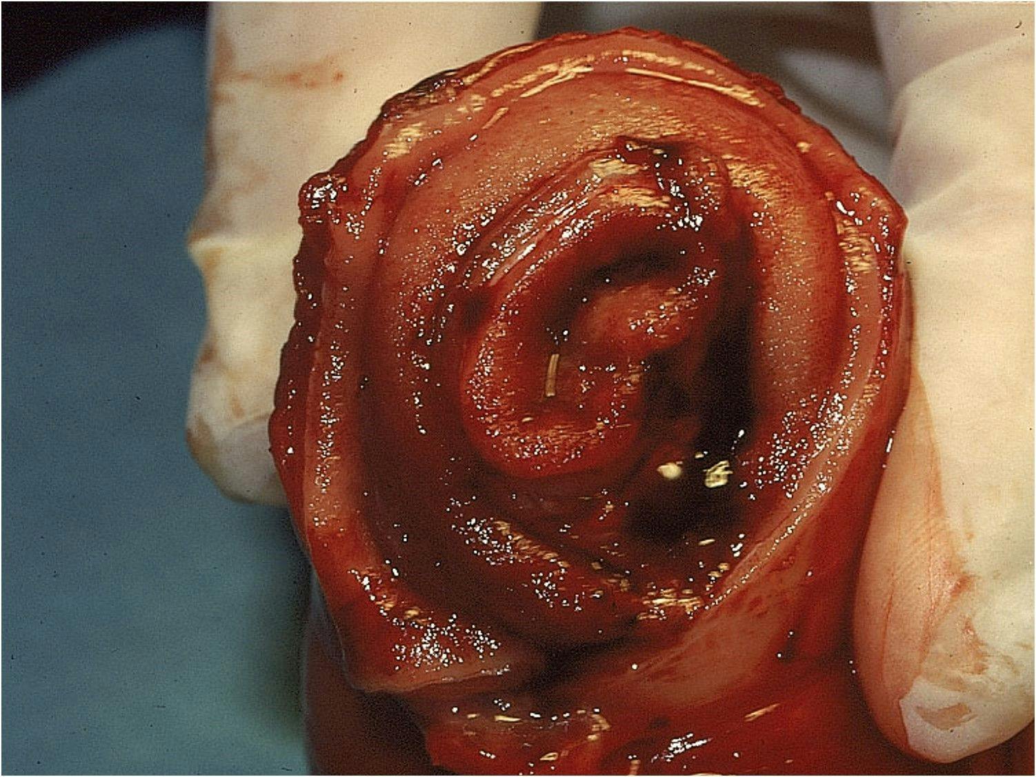 Surgical image of intussusception 