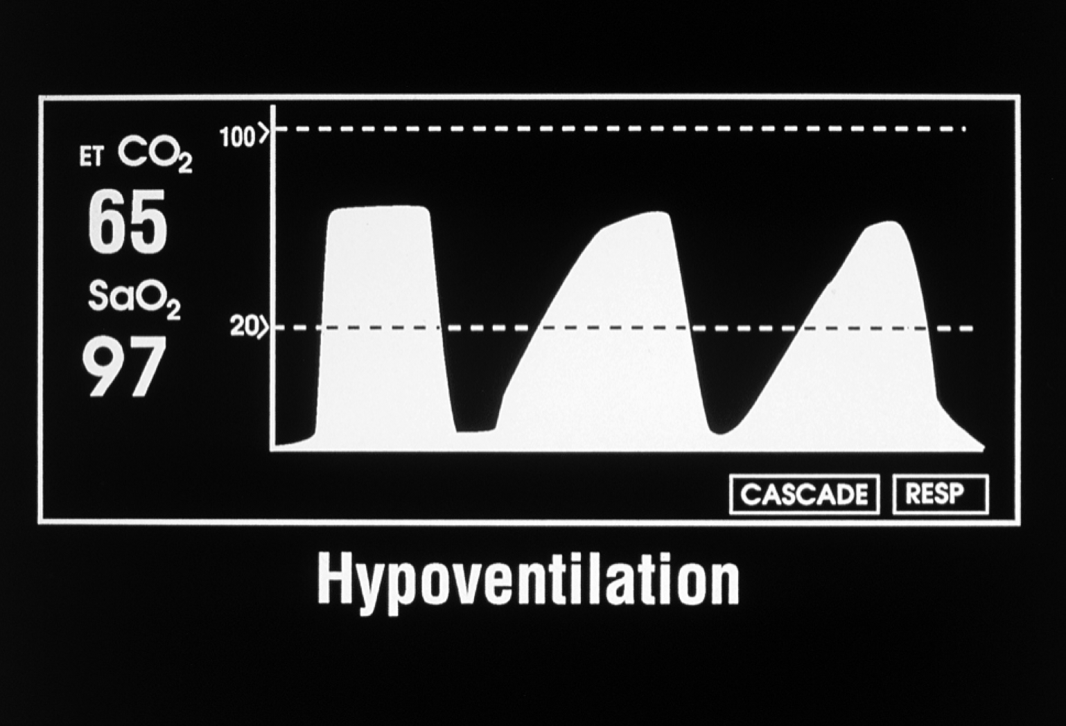 capnogram hypoventilation
