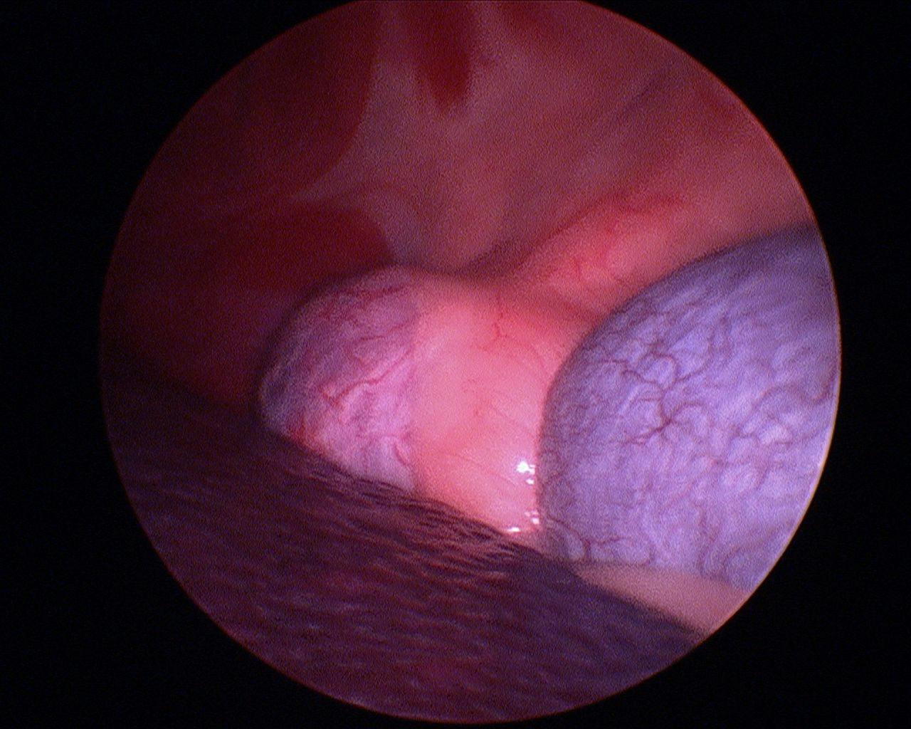 Large left adrenal tumor pictured next to the kidney prior to beginning a laparoscopic adrenalectomy.