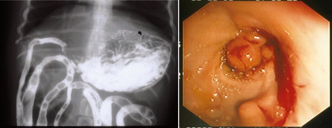 Gastric outflow obstruction