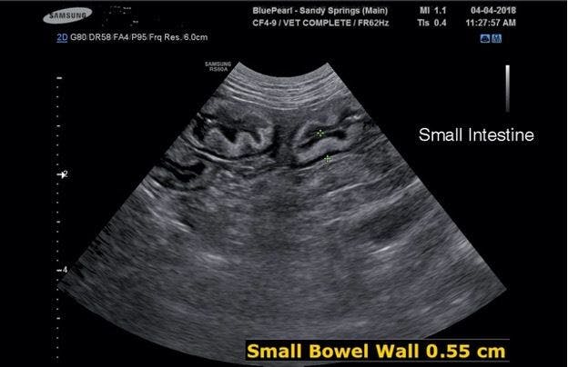 Figure 5. Ultrasound image of the same patient as in Figure 4 demonstrating hyperechoic and thickened intestinal wall in the submucosa layers.