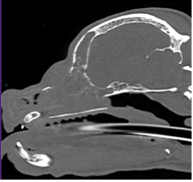 Figure 2. On CT, a large nasal adenocarcinoma is noted within the right nasal cavity, causing both paranasal bone lysis and subtle cribriform plate lysis.