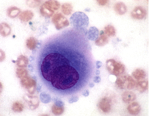Figure 9: Cytologic sample from a patient with confirmed idiopathic hemorrhagic pericardial effusion. The cytologic characteristics of the intrapericardial mesothelial cells can be incorrectly interpreted as representing neoplasia