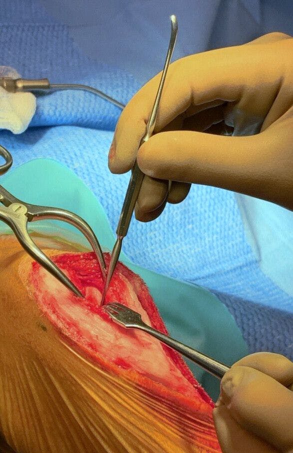 Upping your lateral suture game 