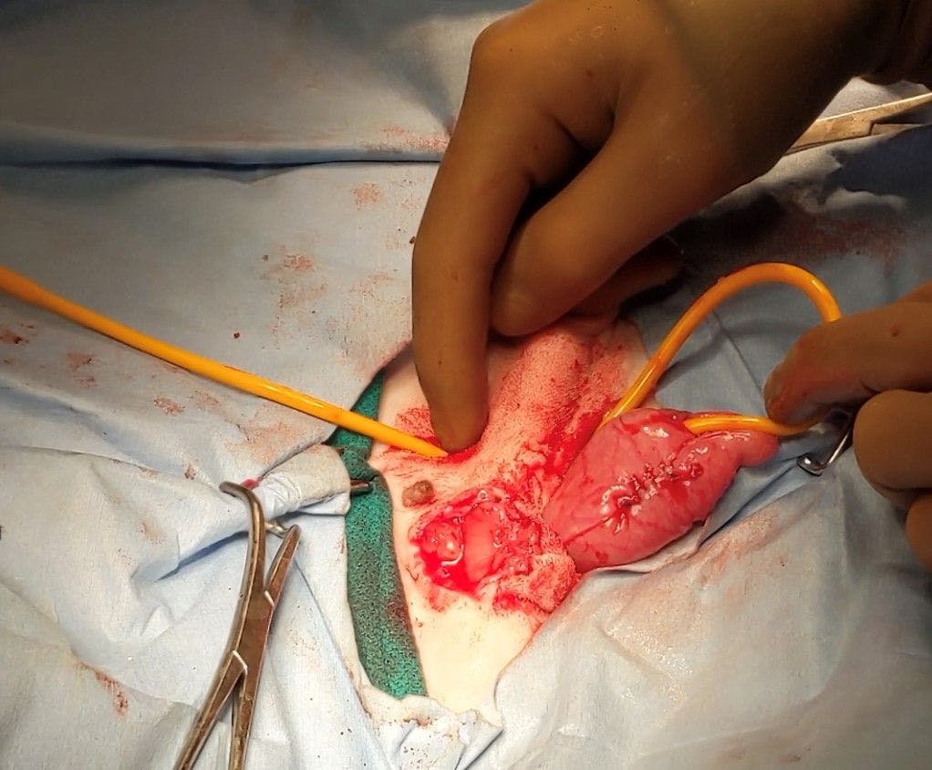 Figure 3. A Foley catheter is inserted through the body wall and into the bladder, where it is secured by saline inflation of the balloon and a purse-string suture in the bladder.