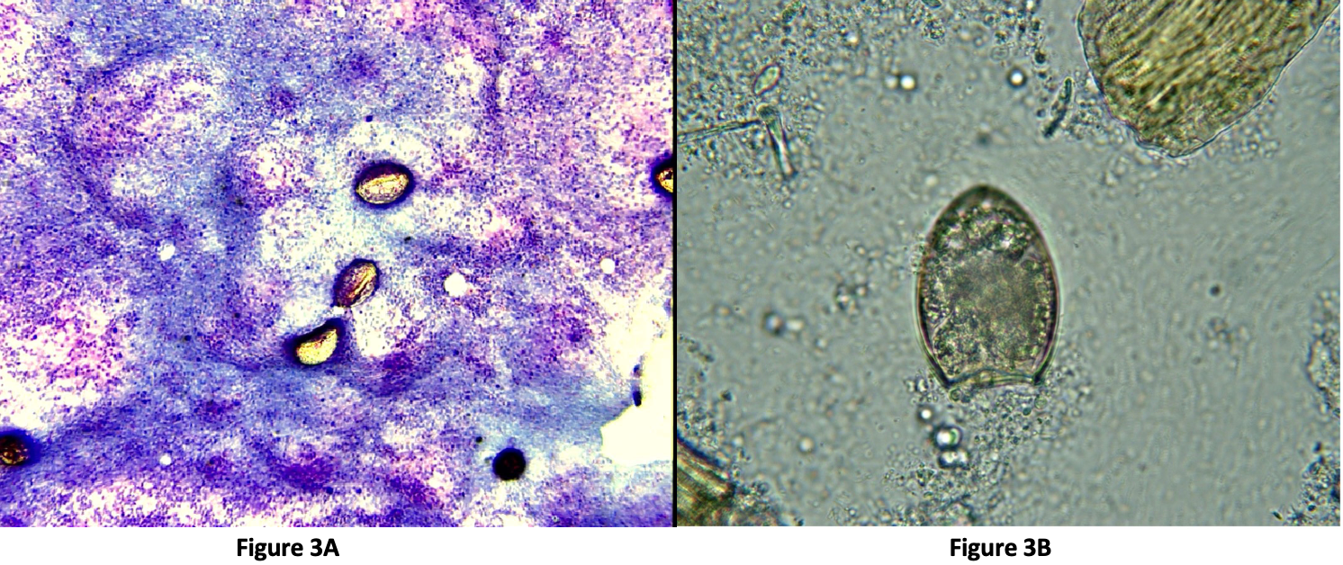 Cytology of a bronchioalveolar wash in a dog with lungworm (Paragonimus) infection demonstrating eggs in the wash (A), as well as the operculum in the fecal sediment (B) in the same dog. (Images courtesy of Jennifer Neel, DVM, DACVP (Clinical), assistant dean of student development and professor of pathology, North Carolina State University College of Veterinary Medicine)
