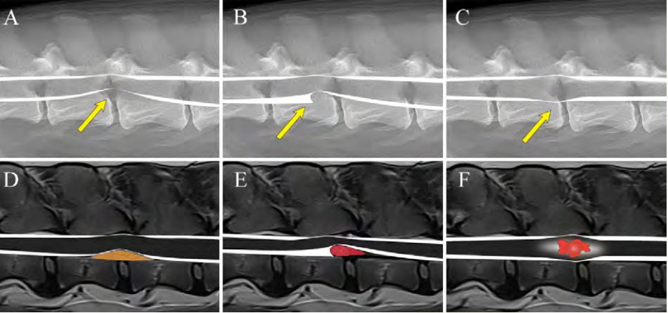 Figure 5A. Myelographic and MRI Patterns of Extradural, Intradural-Extramedullary, and Intramedullary Lesions.

 Illustration depicting the three myelographic patterns and corresponding T2-weighted MR images associated with extradural, intradural-extramedullary (within the subarachnoid space but not within the spinal cord parenchyma), and intramedullary (within the spinal cord parenchyma). The patterns are classified based on attenuation (narrowing), expansion (widening), and deviation of the contrast (myelogram) or signal intensity (MRI) of CSF within the subarachnoid space. With myelography, the lesion is indirectly identified by its effect on the contrast column whereas with MRI, the lesion is visible. Extradural lesions attenuate and deviate the contrast column toward the center of the vertebral canal. (A and D) An extradural lesion like an intervertebral disc herniation results in an extradural pattern. (A, arrow) An intradural-extramedullary lesion expands the subarachnoid space. (B and E) Typically, in one radiographic view, the expanded subarachnoid space abruptly ends (B, arrow) conforming to the shape of the mass which takes on a “golf tee” appearance (golf tee laying on its side). Intramedullary lesions expand the spinal cord or cause swelling. (C and D) The contrast columns become attenuated and deviate away from the center of the vertebral column. (C, arrow).